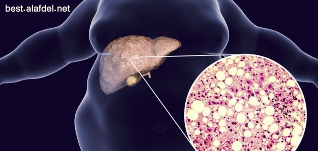 A picture with a scan of the human body showing the liver when talking about obesity damage to the liver